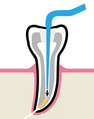 Вертикальная конденсация гуттаперчи - приапикальная
